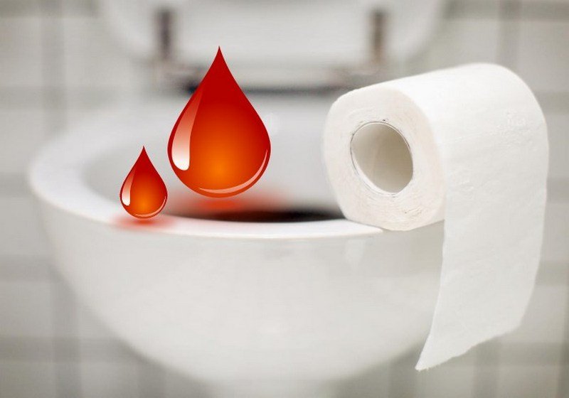 Кровотечение при геморрое: что делать, как остановить кровь?