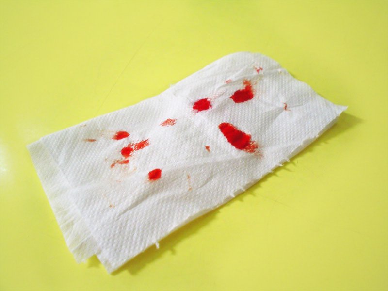 Кровотечение при геморрое