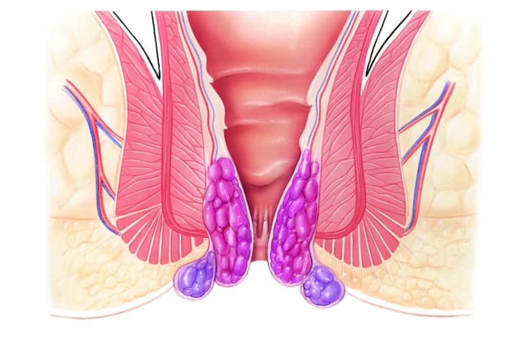 Наружный геморрой
