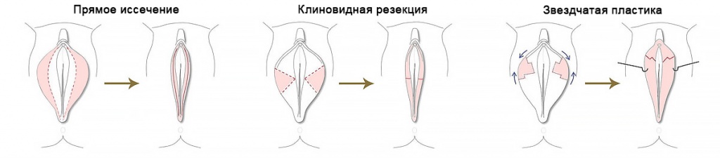 Метод лабиопластики 2.jpg