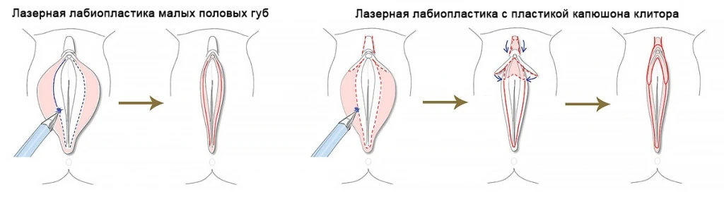 Метод лабиопластики 2.jpg